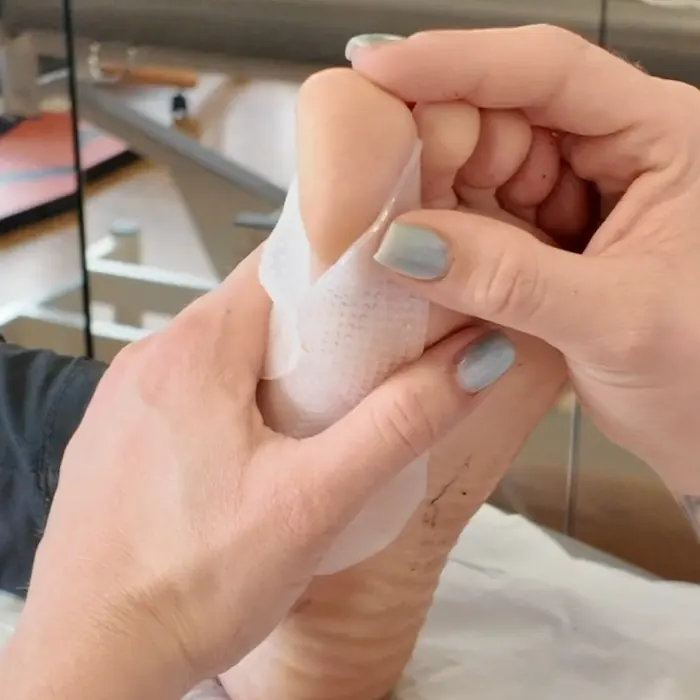 Attelle de nuit sur mesure pour hallux valgus